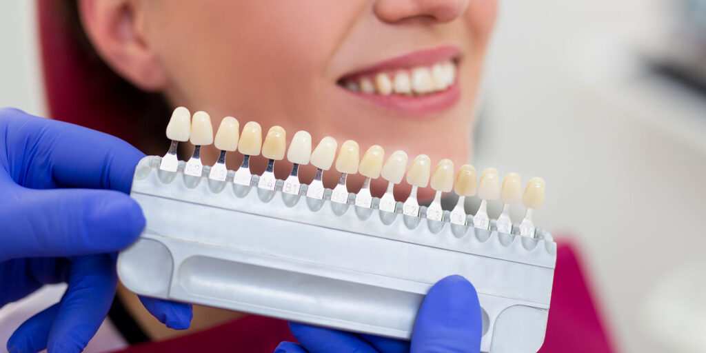 dental veneer choice mobile