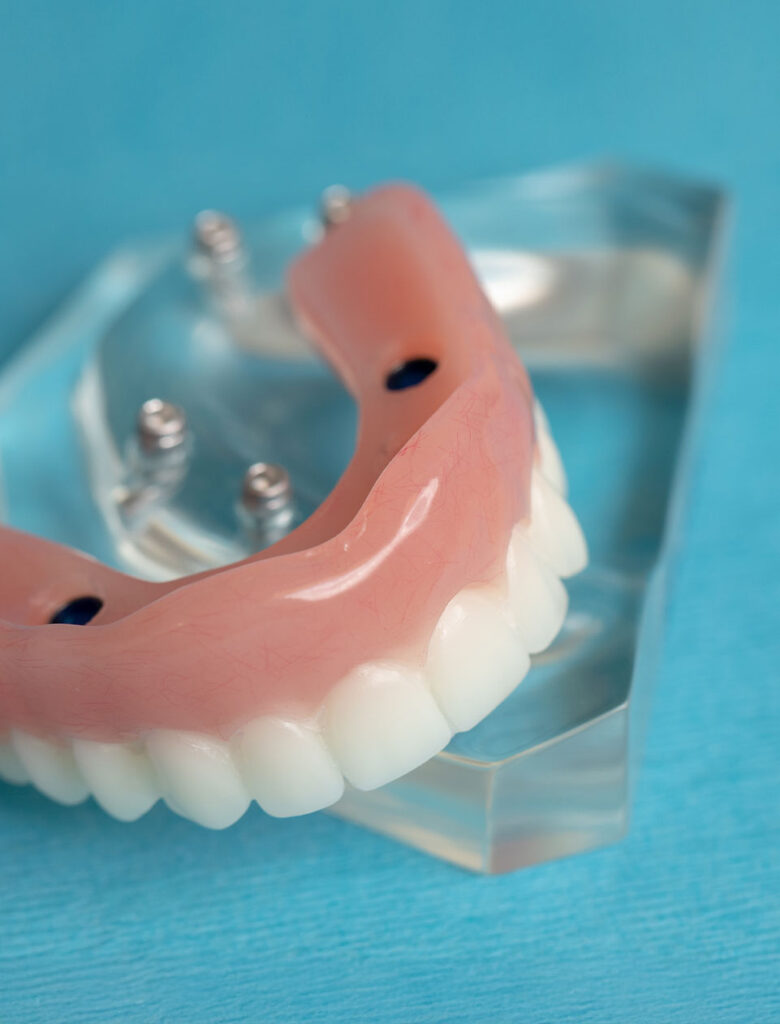 implant supported left
