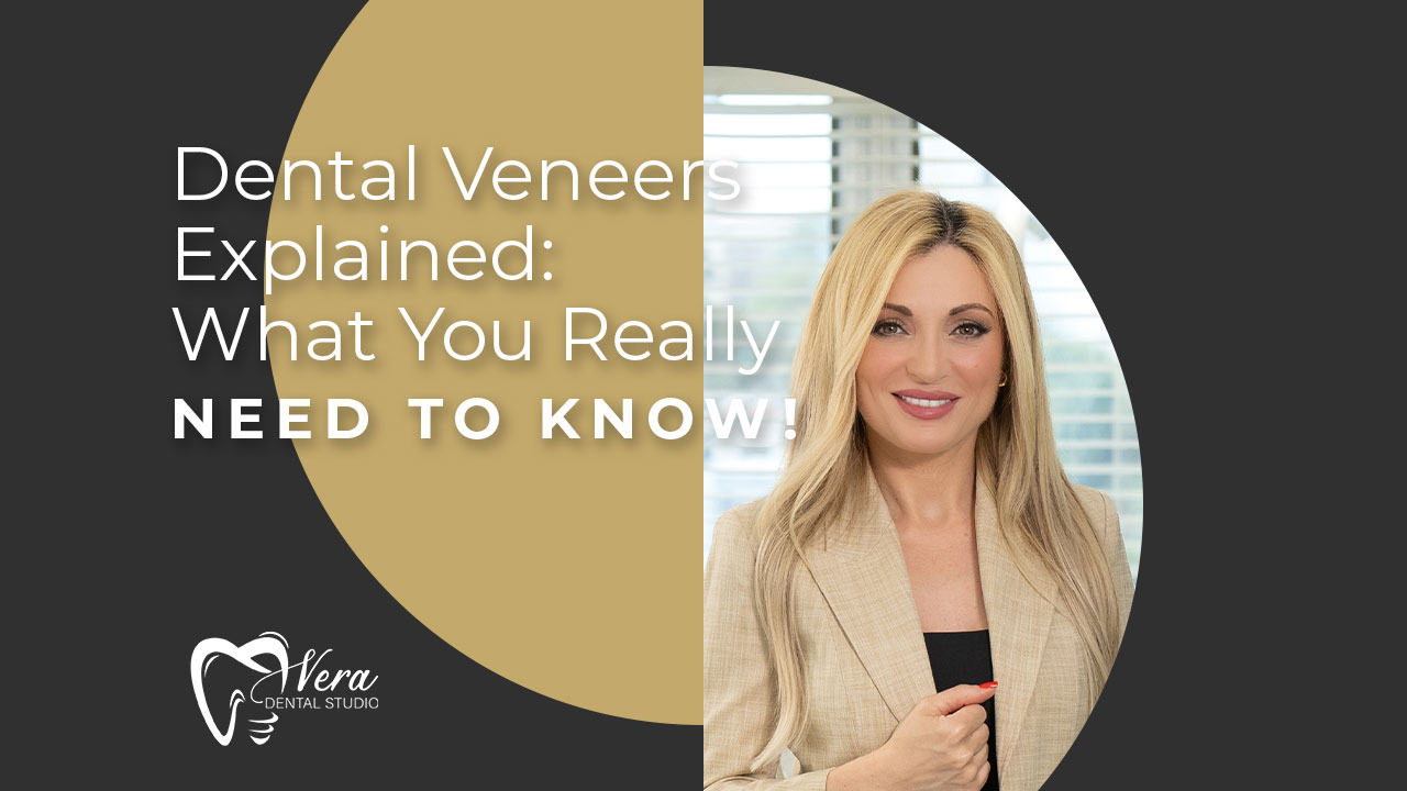 mv3 veneers explained