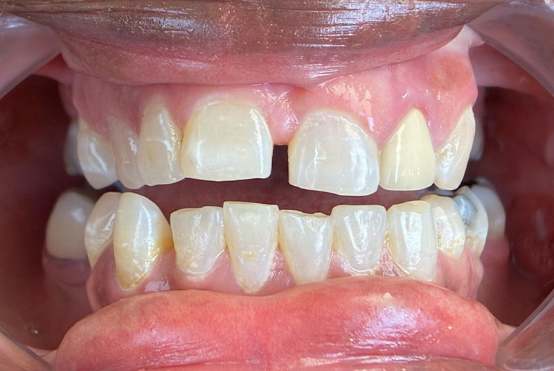 before and after procedure images