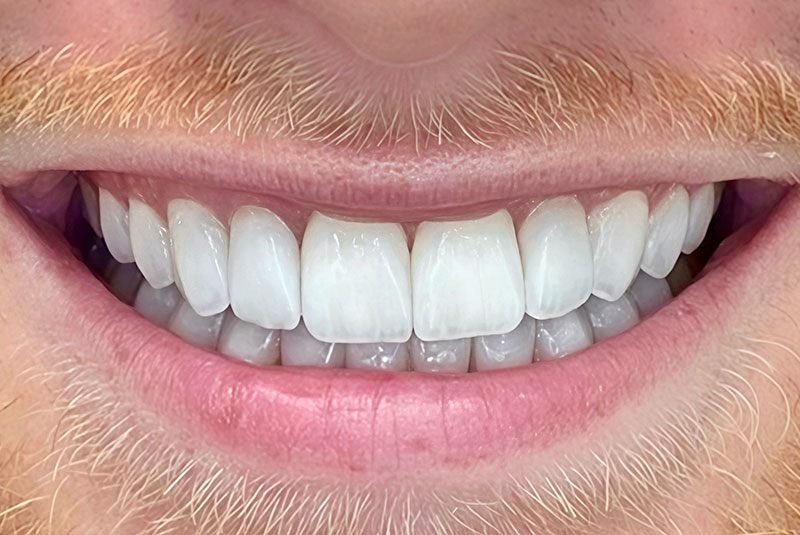 before and after procedure images