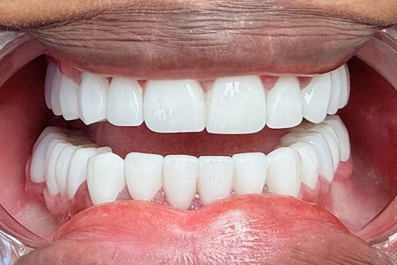 before and after procedure images
