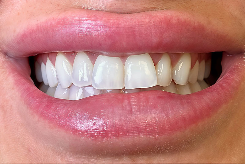 before and after procedure images