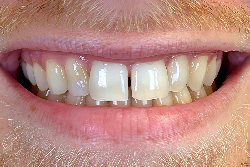 before and after procedure images